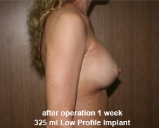 plastic-surgery-breast-augmentation